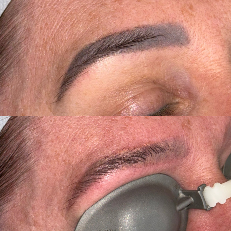 Close-up before-and-after comparison of laser tattoo removal on semi permanent eyebrows on a person's face, with the top panel showing a defined dark eyebrow before laser tattoo removal and the bottom panel showing the brow area during the procedure with a medical eye mask covering the eye.