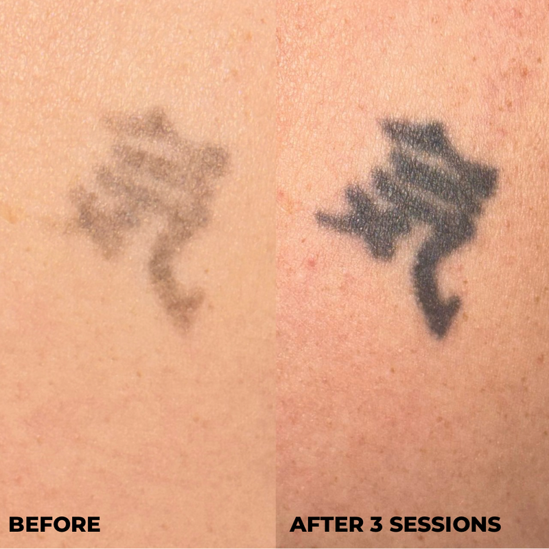 Close-up before-and-after comparison of a tattoo removal or fading treatment on skin, with the left side labeled BEFORE and the right side labeled AFTER 3 SESSIONS.