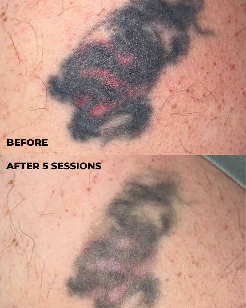 Before-and-after close-up of a tattoo removal or fading treatment on human skin, with the top labeled BEFORE and the bottom labeled AFTER 5 SESSIONS.