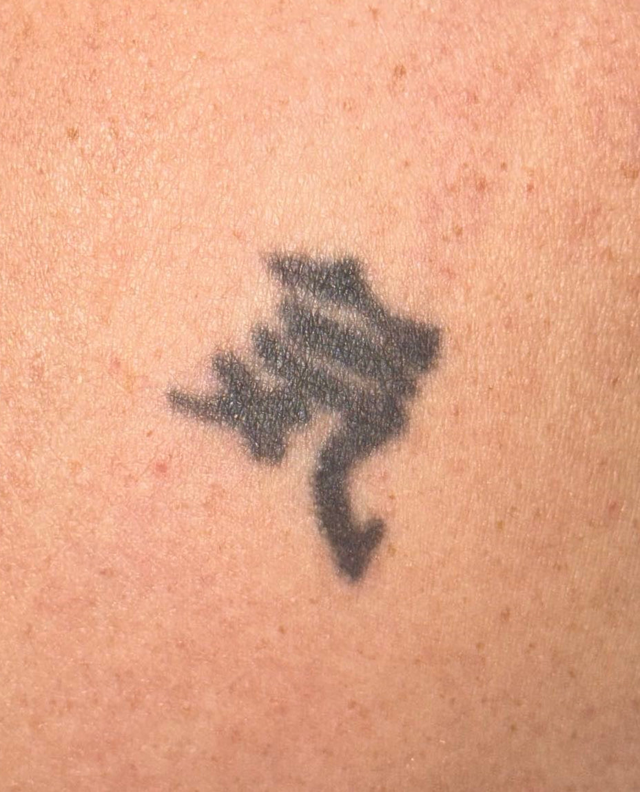 Before laser tattoo removal treatment