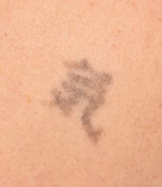 After laser tattoo removal treatment