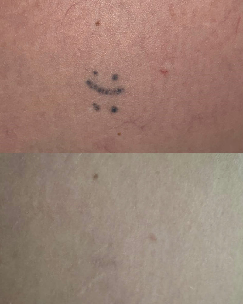Before and after of a laser tattoo removal journey.