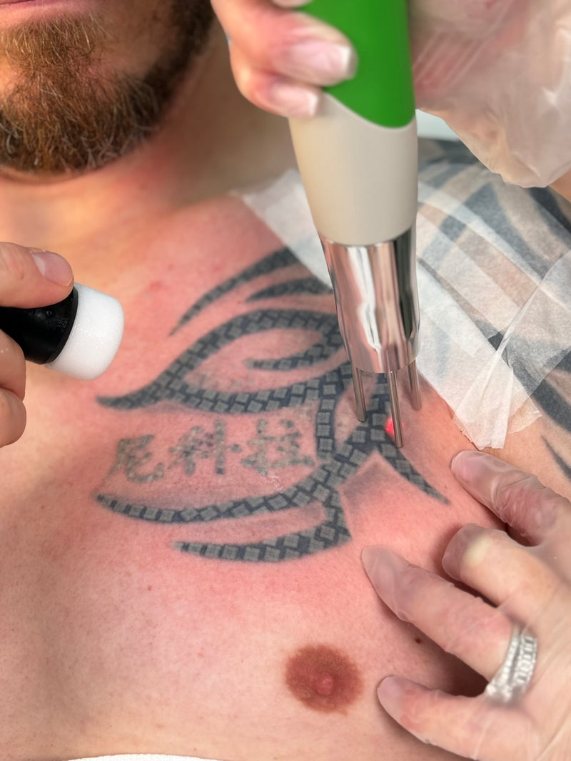 A close-up of a tattoo removal or shading procedure on a person's chest, showing a tattoo machine in the process of removing the tattoo.