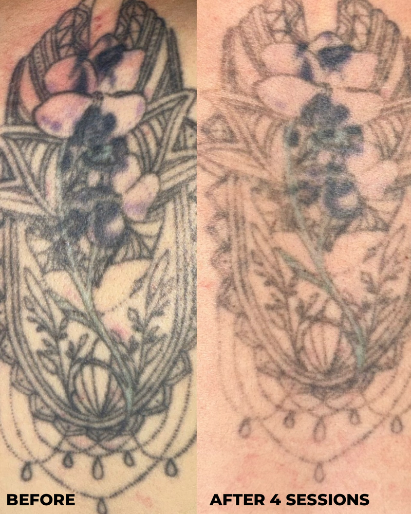 A side-by-side tattoo progress comparison labeled 'BEFORE' and 'AFTER 4 SESSIONS' showing a floral design on skin. The left side shows a darker, freshly tattooed design, and the right side shows a lighter, faded design after four sessions.